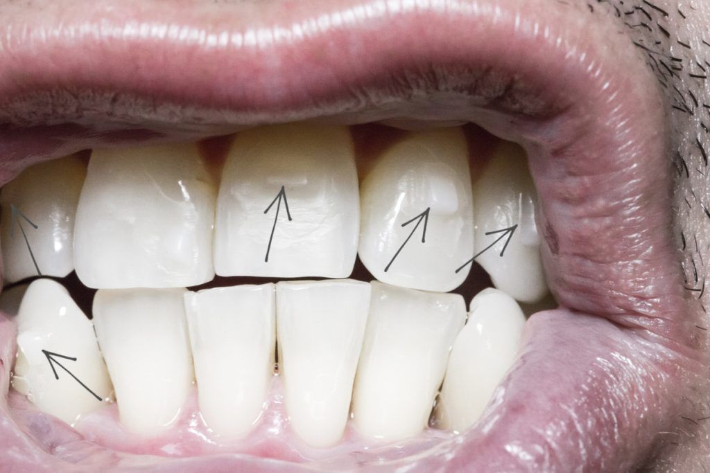 Ataches en Invisalign qué son y para qué sirven IMaxilodental