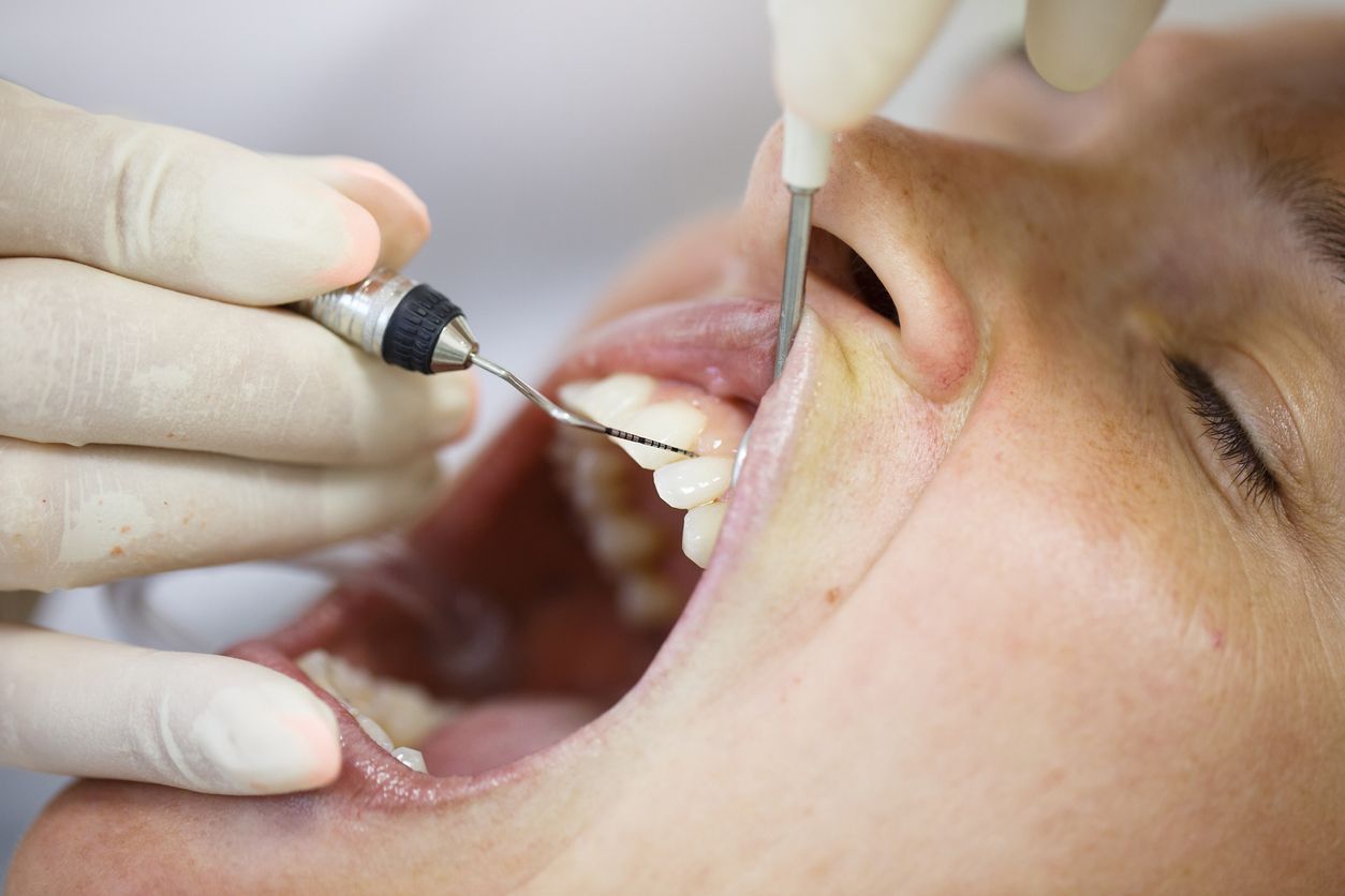 Tratamientos periodontales en Mollet del Vallès- Institut Maxilodental del Vallès